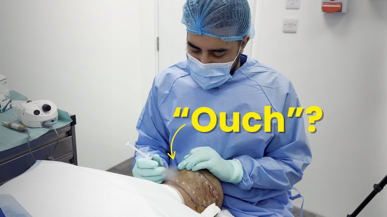 Are Hair Transplants Painful? (Before, During & After)