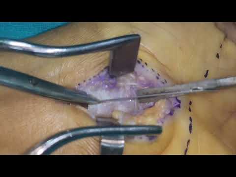 Carpal Tunnel Release Surgery by Dr Sunny Dole