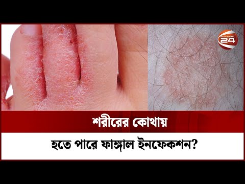 শরীরের কোথায় ফাঙ্গাল ইনফেকশন হতে পারে? | Fungal Infection | Dr Fahmida | Channel 24