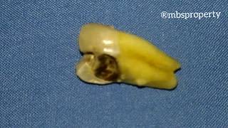 Download lagu Ternyata Begini Keadaan Gigi Setelah DiZoom, Penampakan Gigi Berlubang Dari Perbesaran Kamera. mp3 Download lagu Ternyata Begini Keadaan Gigi Setelah DiZoom, Penampakan Gigi Berlubang Dari Perbesaran Kamera. mp3