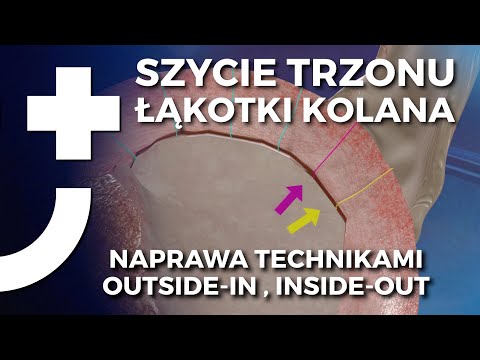 Szycie trzonu łąkotki kolana - techniki OUTSIDE-IN oraz INSIDE-OUT - animacja 3D