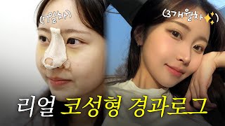 리얼 코성형 경과로그![1일차~3개월차] | 무보형물 코성형, 복코성형, 비염개선 | 첫단추 코성형클리닉