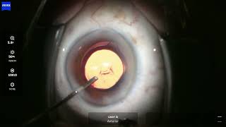 OS 2025 05 13 111248 phaco Eyhance #rare nasal vitreous prolapse after visco removal