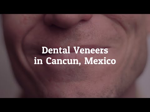 Learn About Dental Veneers in Cancun, Mexico