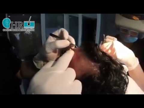 FUE Hair Transplant