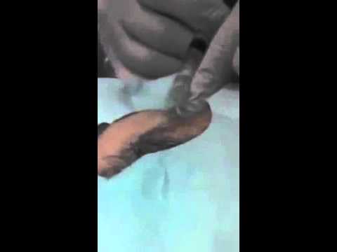 CYST AS HARD AS MARBLE EXPLODES