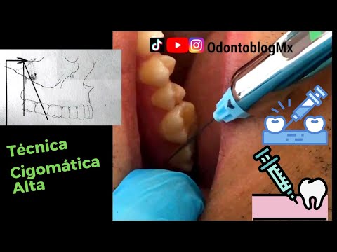 Técnica de Anestesia Cigomática Alta