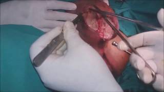 Fournier&#39;s Gangrene of Scrotal area, in diabetic patient, Extensive Debridement - Dr Narotam Dewan