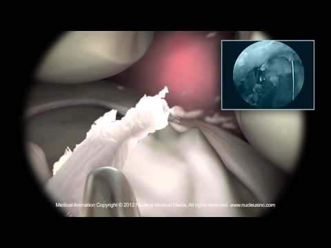 Kniegelenk Kreuzbandriss OP