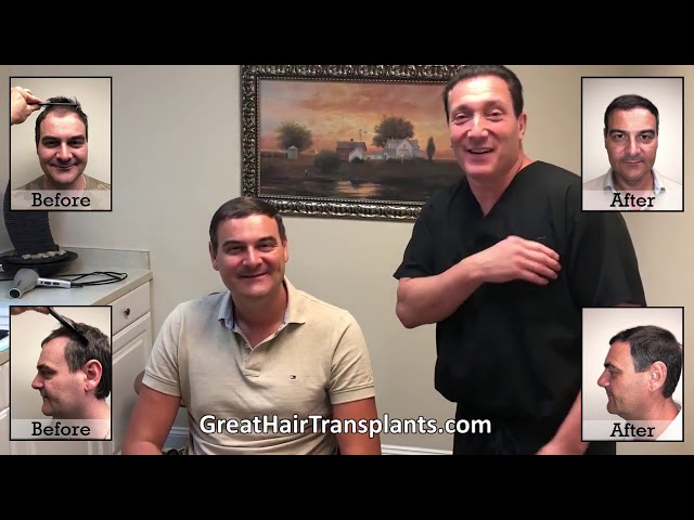 Dr. Brett Bolton Patient Dejan flew in from Serbia for a MaxHarvest Procedure

