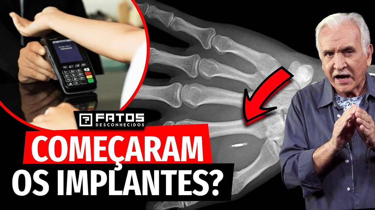 Organização de Santa Catarina prepara microchip para ser implantado no Brasil! - E se for verdade?