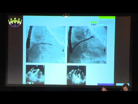David Meerkin & Ignacio Cruz - Case Examples -  Challenges in closing varying LAA morphologies