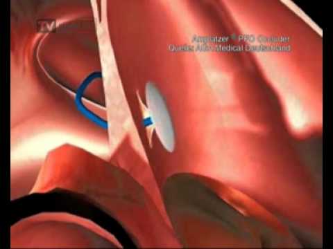Eine Heilung für Prostatakrebs Husten Differentialdiagnose von Prostatitis