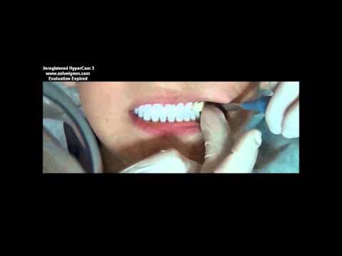 Aplicação de Lentes de Contato em Amelogenese Imperfeita