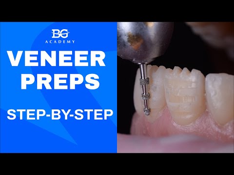 Veneer preps: step by step
