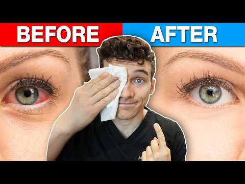 Best Eye Allergy Relief at Home for Red Itchy eyes