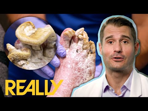 "This Is The Worst Case Of Toe Nail Fungus That I've Seen" | My Feet Are Killing Me