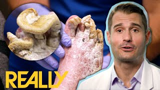 &quot;This Is The Worst Case Of Toe Nail Fungus That I&#39;ve Seen&quot; | My Feet Are Killing Me