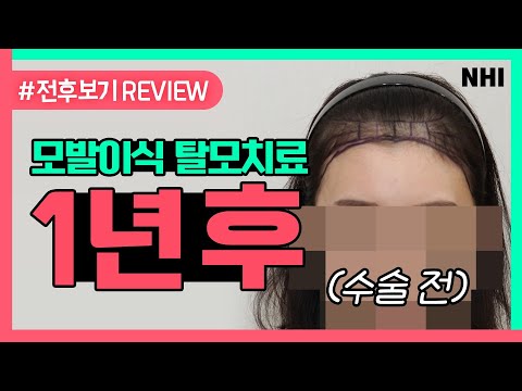 확 달라지는 헤어라인교정 (넓은이마,각진이마 시청 필수)ㅣ전후보기reviewㅣ뉴헤어