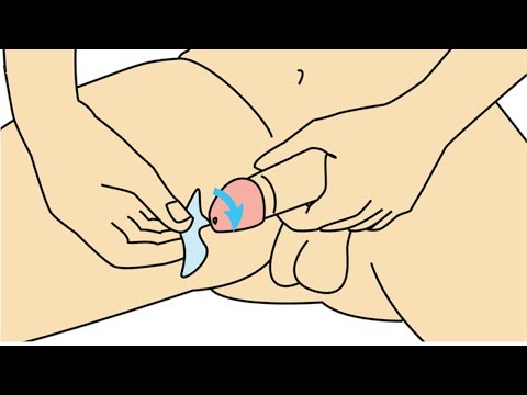Cum se repară penisul