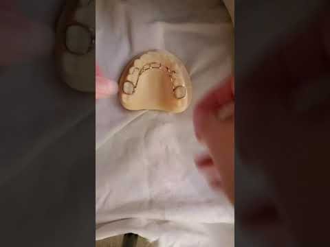 Tongue Thumb Cribs for Braces and Oral Habits