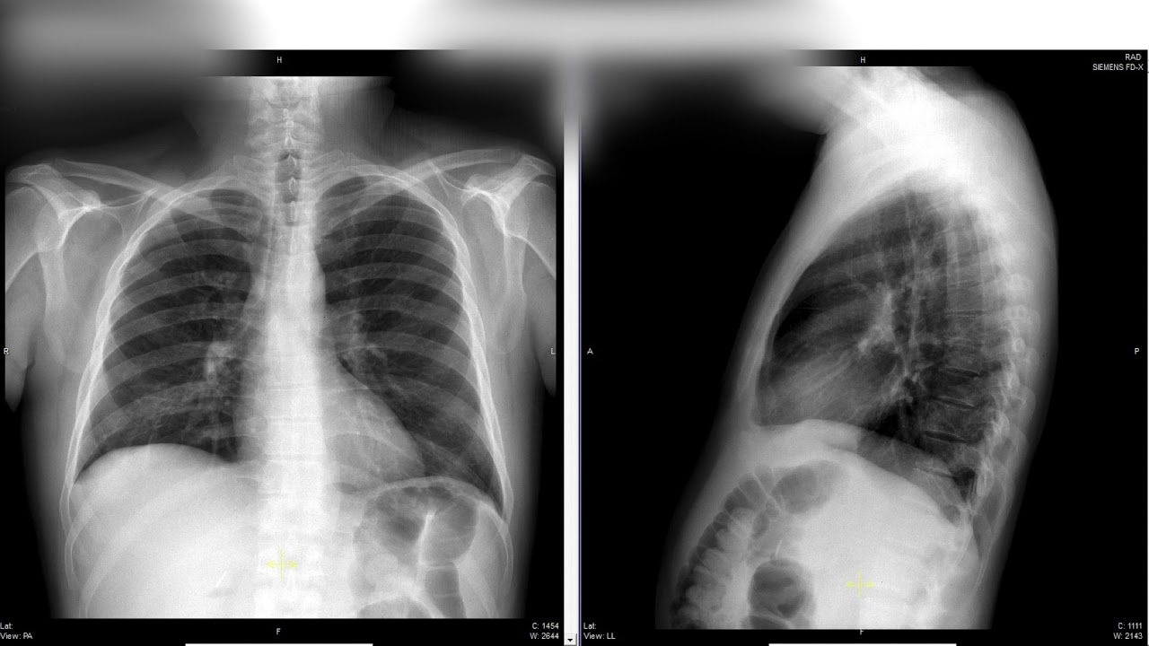Dr. Alfredo Ponce de León y Dr. Richard Chaisson- Revisión de casos