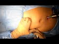 Intraperitoneal Onlay Mesh Repair of Inguinal Hernia