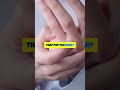 Does Cracking Knuckles Cause Arthritis