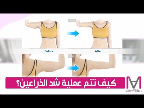 فيديو توضيحي لكيفية إجراء عملية شد الذراعين