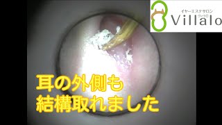 耳掃除動画vol.77「耳の外側も結構取れました」