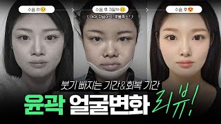 안면윤곽 수술 직후부터 3달 차까지 리뷰해 보겠습니다