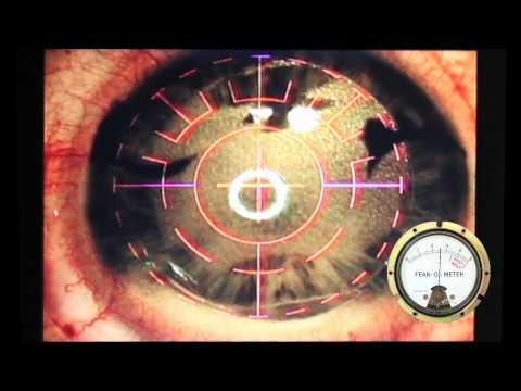 Intralase LASIK Procedure with Fear-o-meter and Pain-o-meter