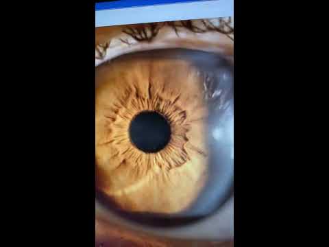 Successful PTK for advanced EKC-related cornea blindness: Kanellopoulos, MD