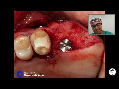 Implant Therapy and Sinus Augmentation