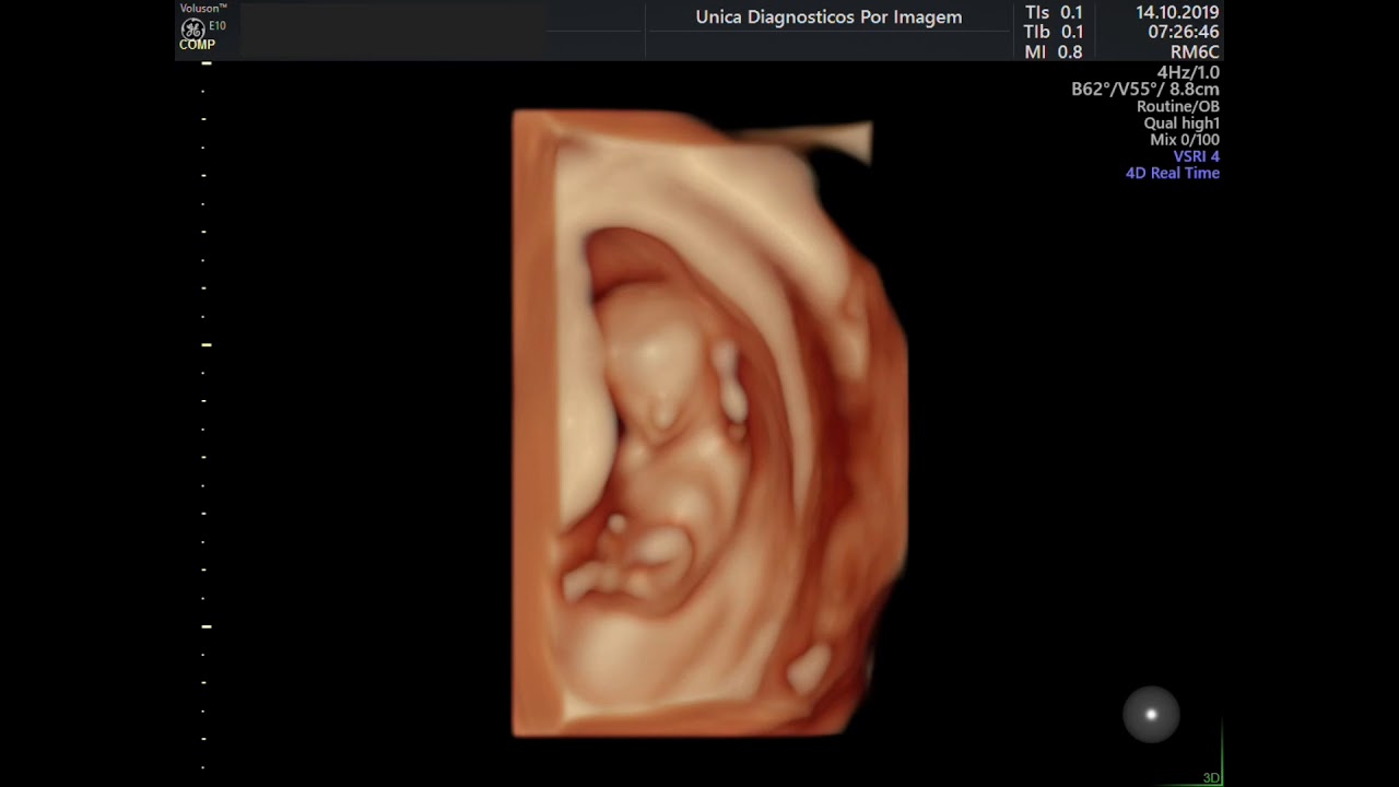 ULTRASSON 3D EM FETO DE 12 SEMANAS E 03 DIAS