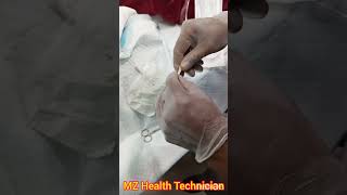 (PCN Catheter) how to Connected Percutaneous Nephrostomy Catheter with Urine bag without connector