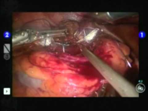 Partial Nephrectomy - Robot Assistance