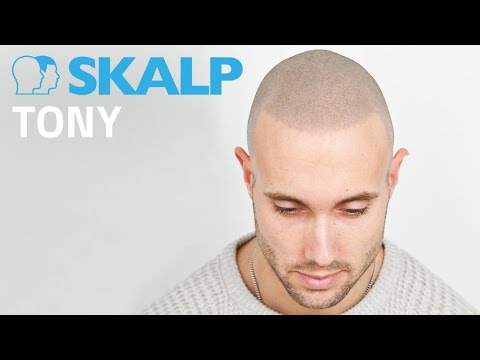 Bestfit TV featuring Skalp® Scalp micropigmentation in Manchester