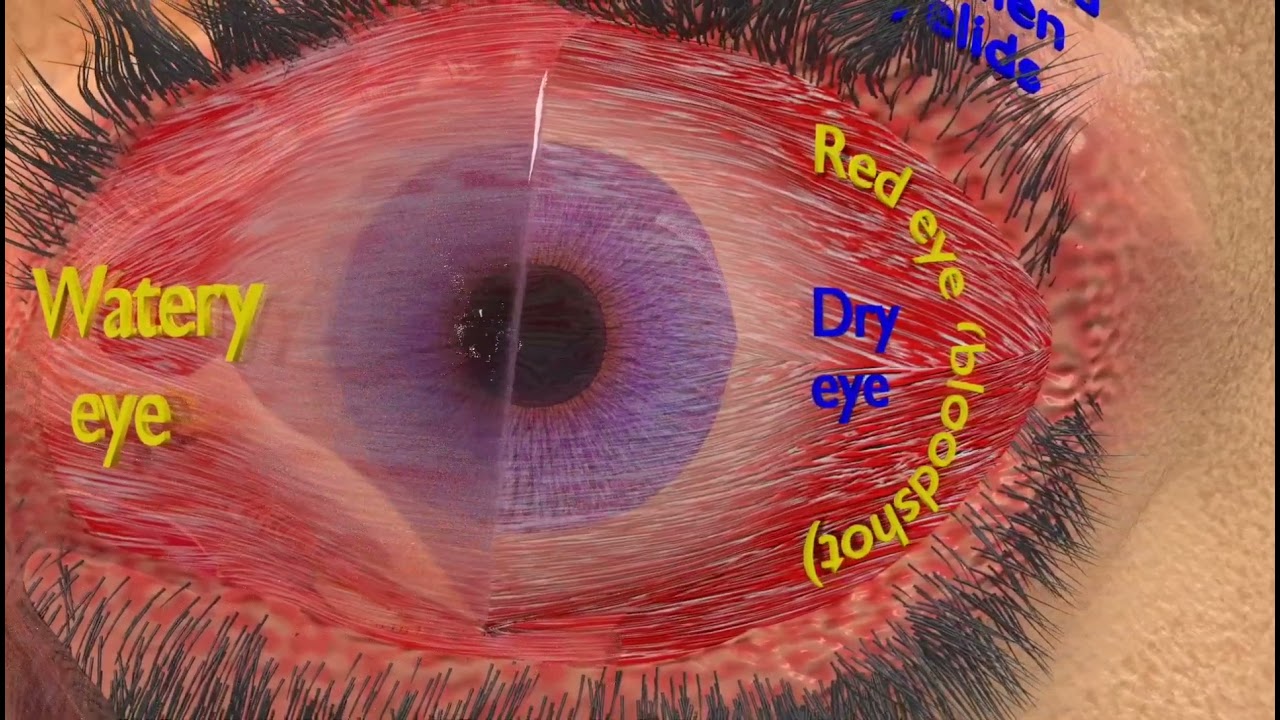 3D thyroid eye disease 3D Model
