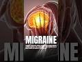 Conquering Migraines Effective Treatment Options Health Wealth And Lifestyle