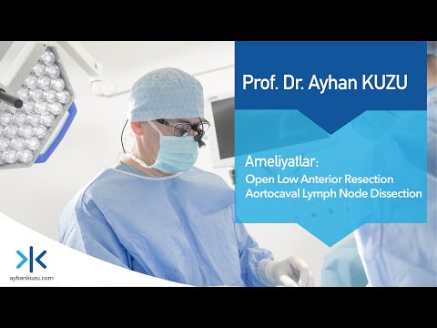 Open Low Anterior Resection Aortocaval Lymph Node Dissection