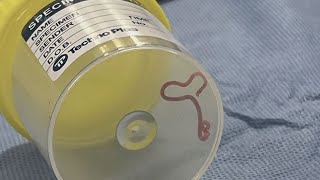 Parasitic worm found in woman