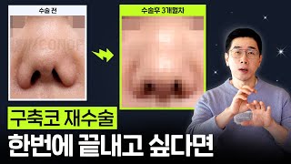 구축코 재수술 2번 하고 싶지 않다면 꼭 보세요! | 구축코, 재건, 부작용