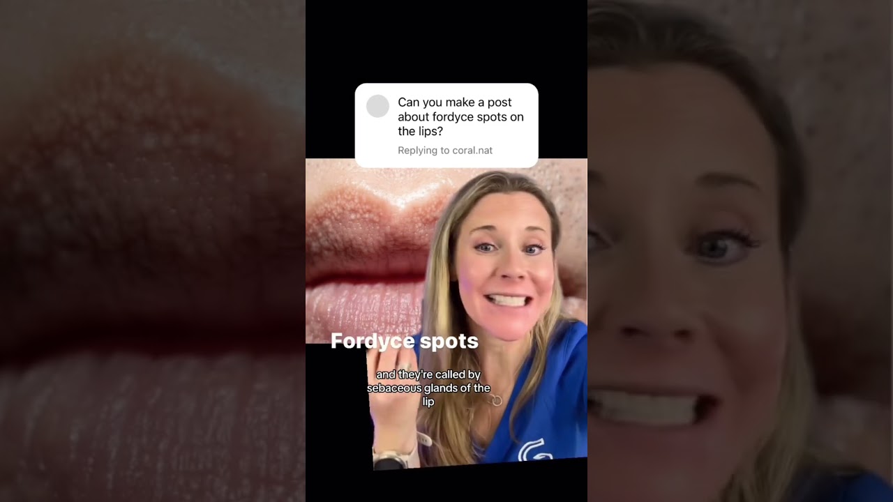 Curious about these little spots on your lips? #fordycespots #lips