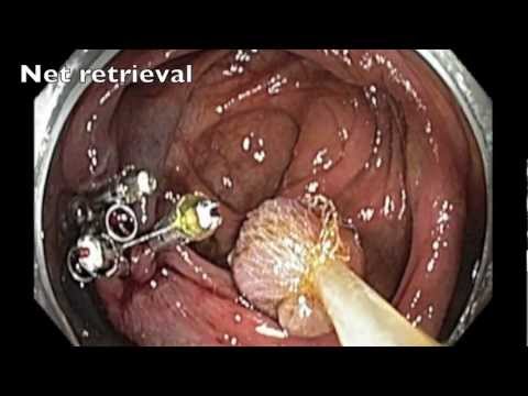Endoskopowa resekcja śluzówkowa siedzącego polipa w jelicie ślepym