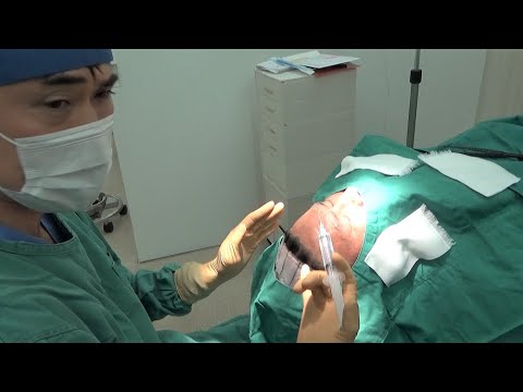 閲覧注意！【手術動画】額リフト 生え際を切開してシワを伸ばし、眉、まぶたをリフトアップします。：MikiTube-症例紹介：美容外科 高須クリニック