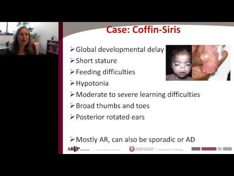 Pinar Bayrak Toydemir - Exome Sequencing as a Diagnostic Tool