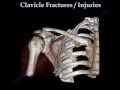 CLAVICLE FRACTURE treatment and repair ...