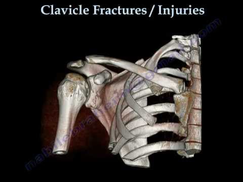 comment soulager fracture clavicule