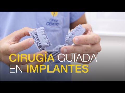 Implantes dentales: cirugía guiada